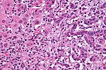 ภาพกล้องจุลทรรศน์ของมะเร็งท่อน้ำดีชนิดในตับ (ซีกขวาของภาพ) เทียบกับเซลล์ตับปกติ (ซีกซ้าย) สีย้อมเอชแอนด์อี