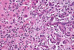 صورة مجهرية لسرطانة الأقنية الصفراوية داخل الكبد (يمين) بالقرب من خلايًا كبدية طبيعية (يسار). (باستعمال صبغة الهيماتوكسيلين واليوزين)