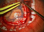 Thumbnail for Craniotomy