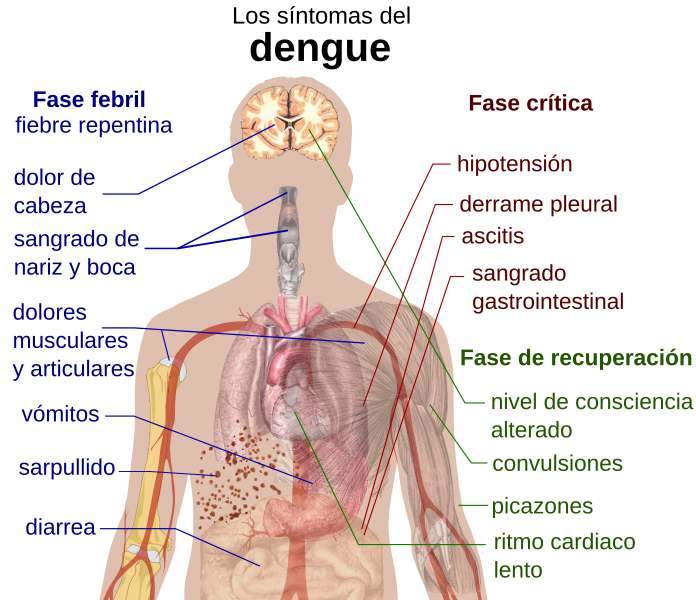 File:Dengue fever symptoms es.svg