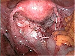 Masszív kismedencei összenövések (adhéziók) endometriózis kapcsán.