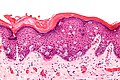 Micrograph of extramammary Paget's disease, H&E stain