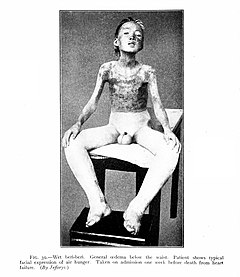 Beriberin aiheuttama jalkojen turvotus viikkoa ennen kuolettavaa sydänhalvausta (1910).