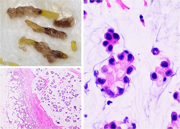 Mucinous carcinoma of the breast: Gross pathology (upper left) of mucinous carcinoma shows gelatinous areas. Histopathology shows clusters or nests of tumour cells floating in pools of extracellular mucin.