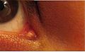 Lacrimal Caruncle Lesion.jpg