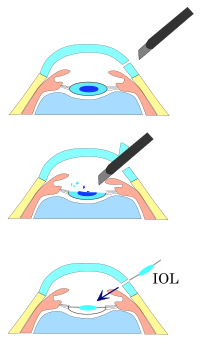 Phacoemulsification and replacement with intraocular lens PEA and IOL.svg