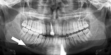 Minimally-displaced fracture in right mandibular. Arrow marks fracture, root canal on central incisor, teeth to the left of fracture do not touch Simple mandible fracture.jpg