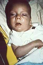 Infant with botulism exhibiting the characteristic flaccid facial musculature, drooping of the eyelids, and lack of expression.