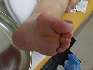Artroza palca stopala.jpg