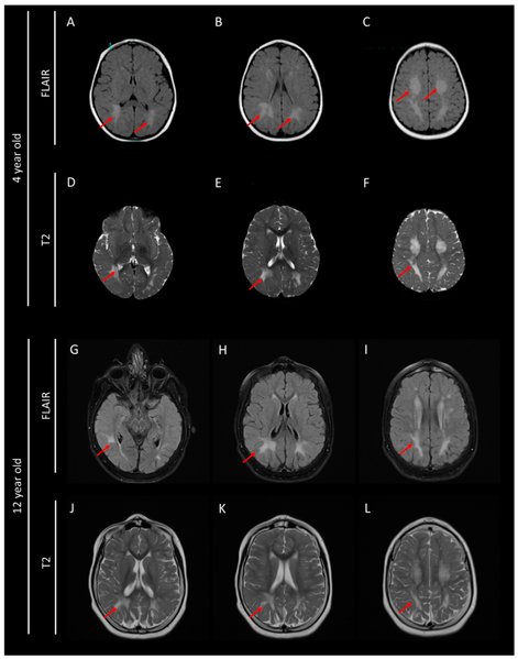 File:Cerebral Folate Deficiency - Brain MRI performed at 4 and 12 years old.png