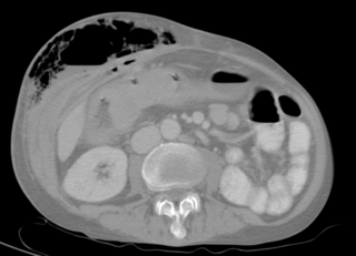 Fistula An abnormal connection between two epithelialized surfaces, often organs