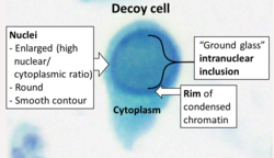 Decoy cell cytology.png