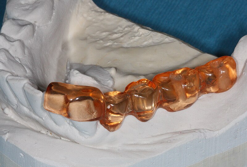 File:Dentalimplantstent.jpg