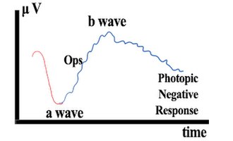 Schematic Electroretinography waves of healthy people. GraphAB ERG Electroretinography.jpg