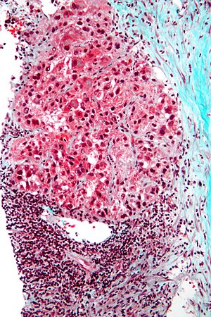 Jetrnocelični Rak: Klinična slika, Diagnostika, Etiologija