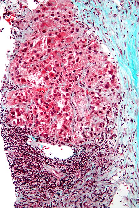 Hepatocellular carcinoma intermed mag.jpg