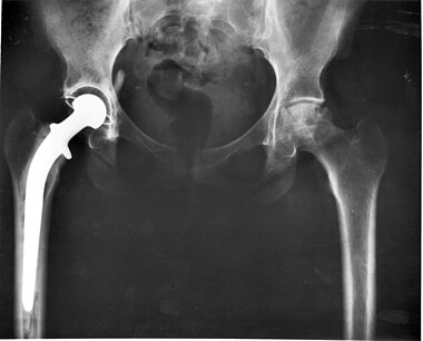 Hip replacement Image 3684-PH.jpg