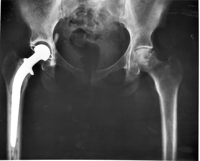 Röntgenfoto van een typisch heupimplantaat in de rechterheup (op de foto links): de metalen heupkop is verankerd in het bovenbeensbot, terwijl in het bekken de heupkom vervangen is door een exemplaar van wit plastic (op de foto transparant)