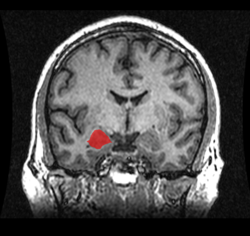  MRI Location Amygdala up 