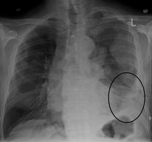 CXR demonstrating a mesothelioma MesotheliomaCXR.png