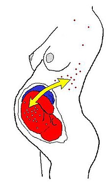 During pregnancy, a two-way traffic of immune cells may occur through the placenta. Exchanged cells can multiply and establish long-lasting cell lines that are immunologically active even decades after giving birth. Microchimerism.jpg