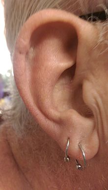 אוזן של גבר בן 63, שצולמה שישה עשר ימים לאחר ניתוח מוז להסרת סרטן תאי קשקש בקצה השמאלי העליון של האוזן, ושלושה ימים לאחר הסרת התפרים.
