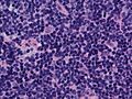 외투세포 림프종 중간 크기의 림프종 세포의 불규칙한 핵 윤곽과 분홍색 조직 세포가 존재한다. 면역조직화학 검사 결과, 림프종 세포는 CD20, CD5, 사이클린 D1을 발현했다.(고출력 현미경 관찰, H&E).