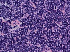 Mantle cell lymphoma: Notice the irregular nuclear contours of the medium-sized lymphoma cells and the presence of a pink histiocyte. By immunohistochemistry, the lymphoma cells expressed CD20, CD5, and Cyclin D1 (high-power view, H&E)