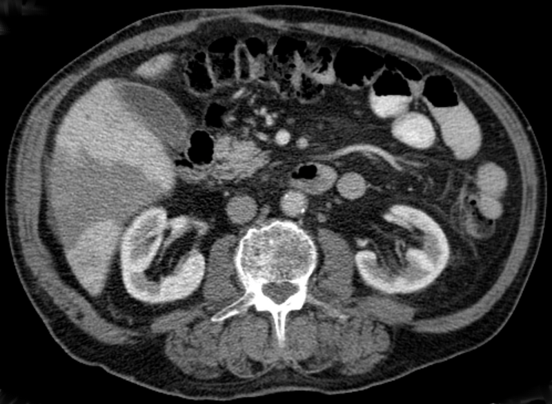 File:Pfortaderthrombose Leberteilinfarkt 005.png