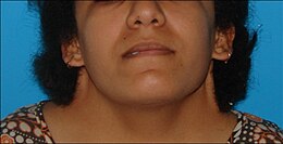 Webbed neck in a teenage girl with Turner syndrome Preoperative webbed neck in Turner syndrome.jpg