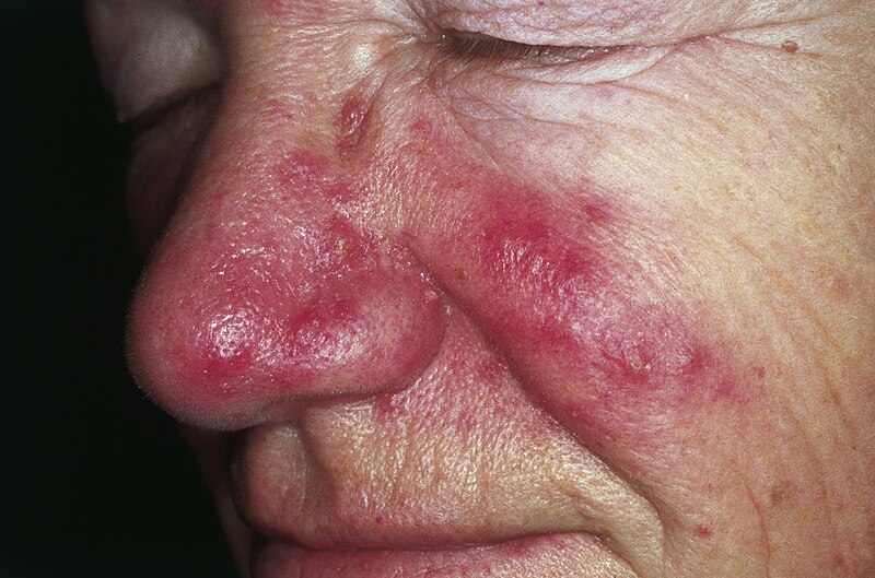 File:Rosacea 01.jpg