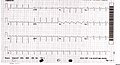 August 23: ECG from a patient with confirmed Takotsubo cardiomyopathy