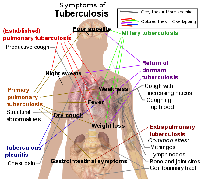 Symptoms of variants and stages of tuberculosis