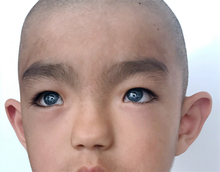 Facial appearance of a boy from China with Waardenburg syndrome type 1 Waardenburg syndrome type 1.png