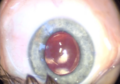 Augenoperation-implantierbare-kontaktlinse-10.png