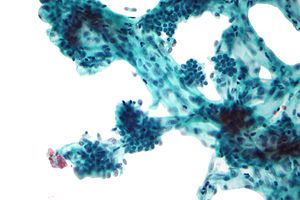 Micrograph of a papillary neoplasm of the breast. FNA specimen. Pap stain.