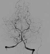 Cerebral angiogram showing a transverse projection of the vertebrobasilar and posterior cerebral circulation. Cerebral angiography, arteria vertebralis sinister injection.JPG