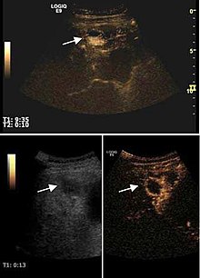 Fig. 14. Small HCC is seen at top (nodule in nodule). Efficient chemoembolization of the nodule (bottom). CEUS examination shows no circulatory signal within the nodule. Doppler ultrasound before and after embolization of hepatocellular carcinoma.jpg