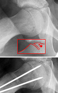 <span class="mw-page-title-main">Slipped capital femoral epiphysis</span> Medical condition