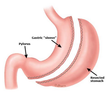 Bariatric Surgery : Types, Procedures, Benefits & Results