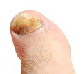 File:Onychomycosis (tinea unguium).jpg - Wikimedia Commons