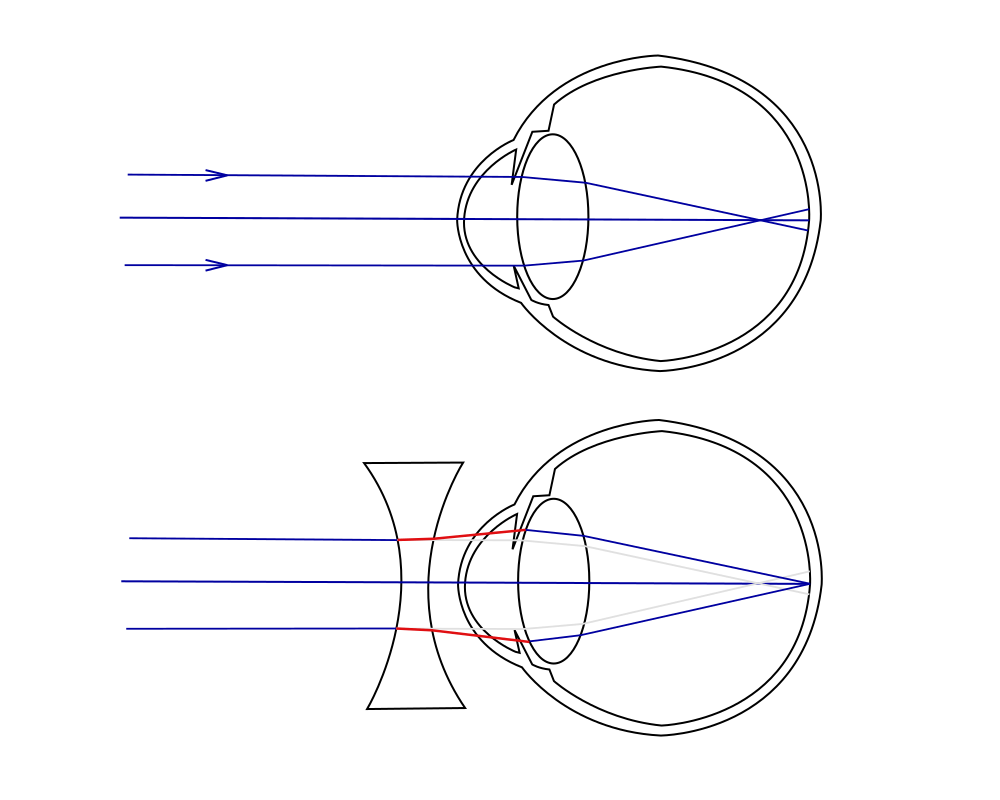 Коррекция зрения с помощью линз. Близорукость схема глаза. Близорукость ход лучей в глазе. Дальнозоркость схема глаза. Дальнозоркость ход лучей.