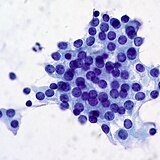 Een bijschildklieradenoom, fijne-naaldbiopsie. Tumorcellen paars, tussenliggend bindweefsel blauw.