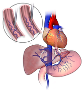 Sclerotherapy (Illustration).png