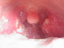 White exudates at the back of the mouth, a manifestation of strep throat. Streptococcal pharyngitis 1.jpg