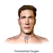 Transtracheal Oxygen (Adult).png