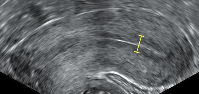 A triple-line endometrium is associated with better IVF outcomes.