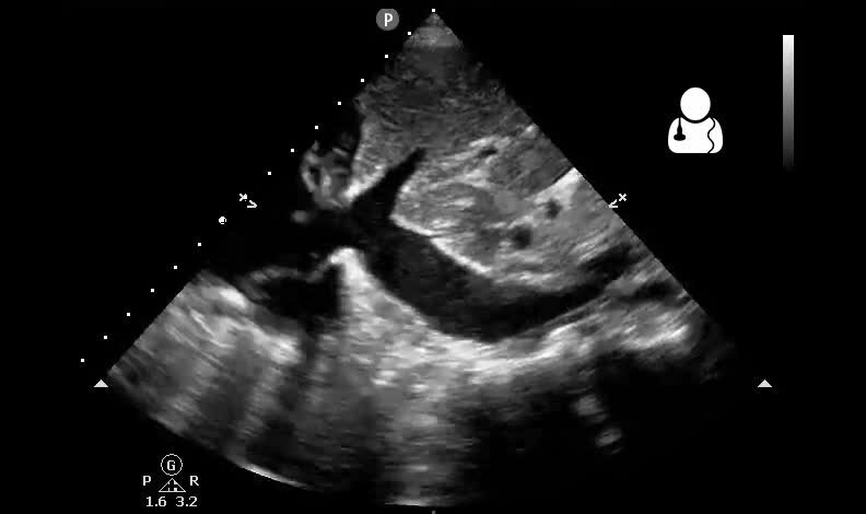 ملف:UOTW 48 - Ultrasound of the Week 4.webm