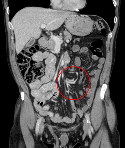 تصوير مقطعي محوسب إكليلي لمنطقة البطن يظهر انفتال كما يظهر على شكل التواء بكتلة الأمعاء