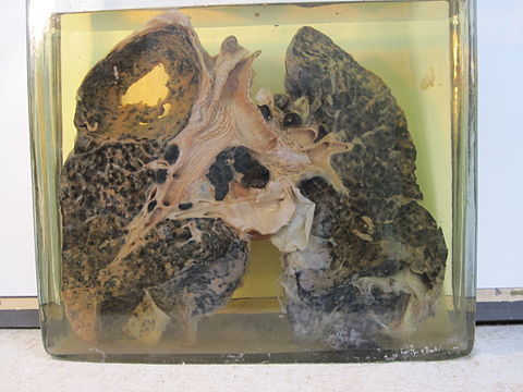 Miner's lung with silicosis and tuberculosis